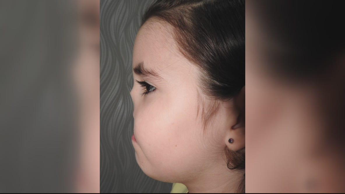 Royal Oak plastic surgeon rebuild's girl's nose, lip with 10-hour microsurgery